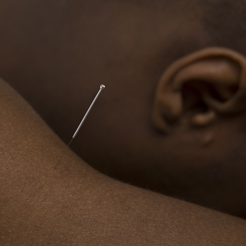 acupuncture