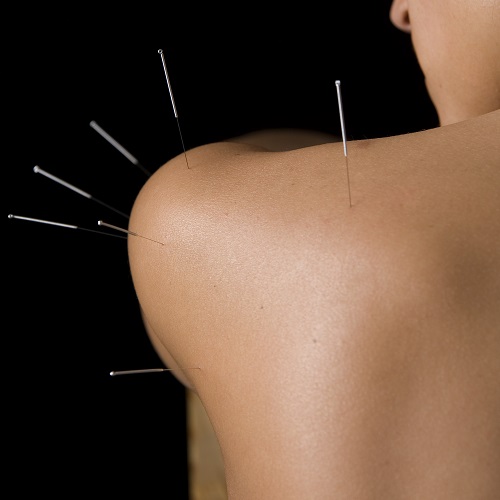 acupuncture needles in a shoulder and upper arm